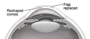 Cross section of eye showing reshaped cornea and flap replaced.