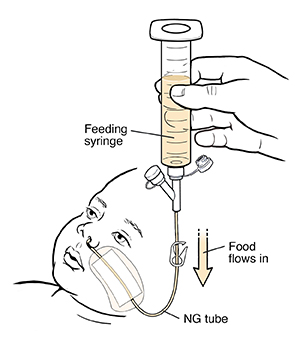 Hand holding syringe filled with liquid food attached to infant's nasogastric tube. Food flowing from syringe into tube.