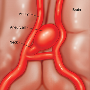 Closeup of brain showing artery with saccular aneurysm.
