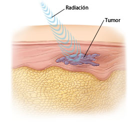 Corte transversal de la piel donde pueden verse ondas de radiación de dosis alta que se dirigen al tumor.