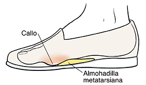 Vista lateral de un pie en un zapato que muestra la almohadilla metatarsiana y un callo.