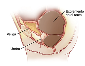 Corte transversal visto de lado de la pelvis de un niño donde pueden verse la vejiga, la uretra y el recto detrás de la vejiga. El recto sobresale hacia la vejiga porque hay una gran cantidad de materia fecal en su interior. La vejiga está llena de orina.
