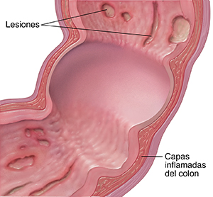 Corte transversal del colon con enfermedad de Crohn.