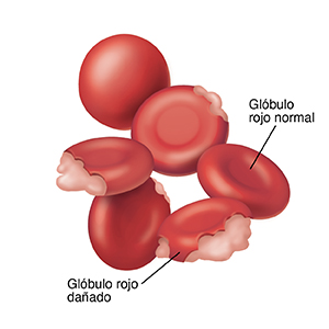 Glóbulo rojo normal con forma de disco. Un glóbulo rojo tiene forma esférica. Cuatro glóbulos rojos están dañados y se están desintegrando.