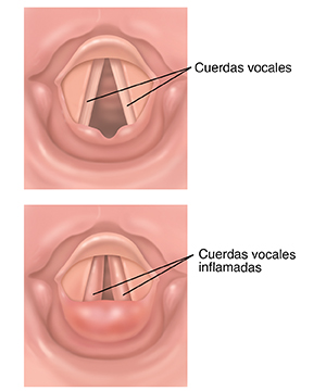 Vista superior de cuerdas vocales normales. Vista superior de cuerdas vocales inflamadas.