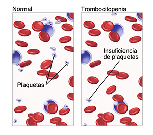 Vista microscópica de sangre con una cantidad normal de plaquetas. Vista microscópica de sangre con muy poca cantidad de plaquetas.