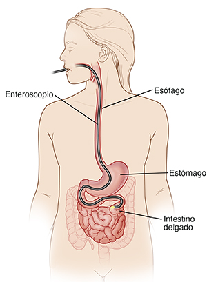Esquema de la cabeza y el tórax que ilustra el enteroscopio en la boca, el esófago, el estómago y más allá del duodeno en el interior del intestino delgado.