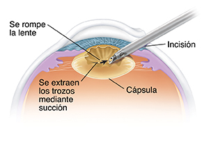 Corte transversal del ojo donde se muestra el instrumento que extrae el cristalino.