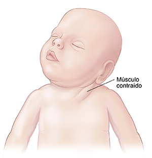 Vista frontal de un bebé con un músculo del cuello contraído y la cabeza hacia un lado.