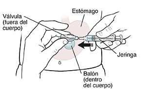 Vista frontal de un abdomen donde se ve una sonda de gastrostomía, un globo y una jeringa. Manos conectando la jeringa a la sonda de gastrostomía.