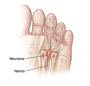 Vista inferior de un pie donde se observa un neuroma entre los huesos de los dedos.