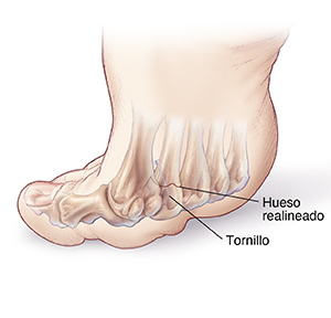 Vista inferior del pie flexionado donde se observa el metatarso realineado para ayudar a curar las callosidades plantares en el metatarso del pie.