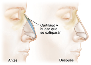 Vista lateral de una cabeza que muestra el antes y el después de la rinoplastia. El cartílago de la nariz que hay que extraer está resaltado en azul.