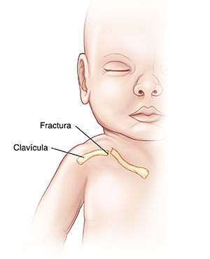 Contorno de un bebé con una fractura de clavícula.