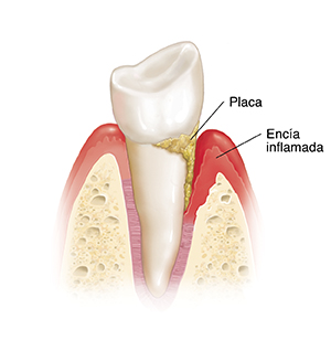 Vista lateral de un diente en el hueso donde se observan la placa y la encía inflamada.