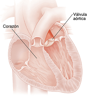 Corte transversal del corazón que muestra una válvula aórtica con estenosis. 