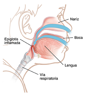 Vista lateral de la cabeza de un niño que muestra la anatomía de la garganta donde puede verse la epiglotis inflamada.