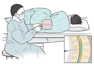 Proveedor de atención médica le inserta una aguja en la parte inferior de la columna vertebral a un paciente tapado y acostado de lado. El recuadro muestra un corte transversal de la columna lumbar con la aguja insertada en el conducto vertebral.