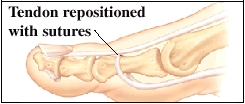 Imagen de un tendón reposicionado, con suturas