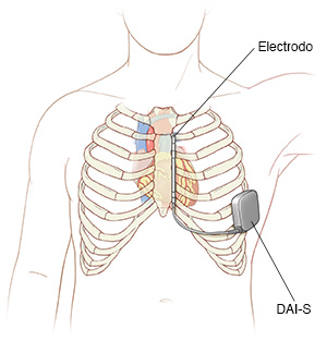 Vista frontal de la caja torácica y del corazón donde se observa la colocación de un desfibrilador automático implantable subcutáneo (DAI-S).