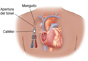 Contorno del pecho de un hombre donde se muestra un catéter tunelizado que ingresa a la aurícula derecha del corazón.