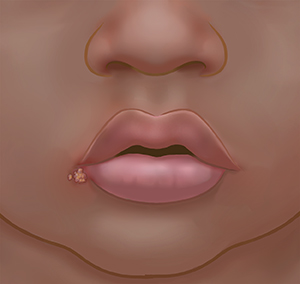 Primer plano de una boca en donde se ve una ampolla en el labio inferior.