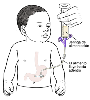 Contorno de un bebé con una sonda introducida en el estómago. El puerto de alimentación está cerca de la piel y la abrazadera en el tubo de extensión está abierta. La jeringa de alimentación está insertada en el tubo de extensión. El alimento líquido circula hacia el estómago del bebé.
