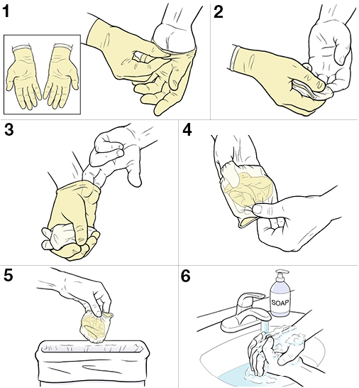 6 steps for removing sterile gloves