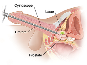 Cross section of prostate showing cystoscope inserted into urethra and prostate. Laser in cystoscope is removing prostate tissue.