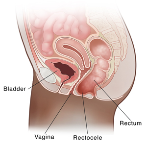 Side view cross section of female pelvis showing rectum sagging into vagina, called rectocele.